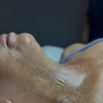 Skin treatment at PureBeauty Spa